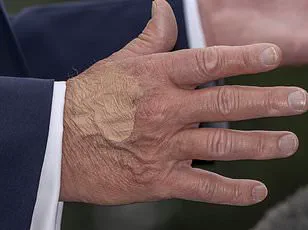 Defying Medical Advice: Trump's High-Dose Aspirin Regimen Raises Expert Concerns