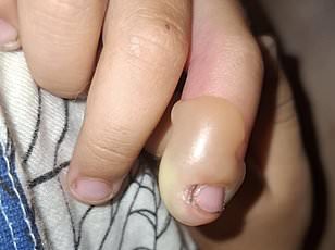 Six-year-old boy suffers severe burns after playing with giant hogweed.