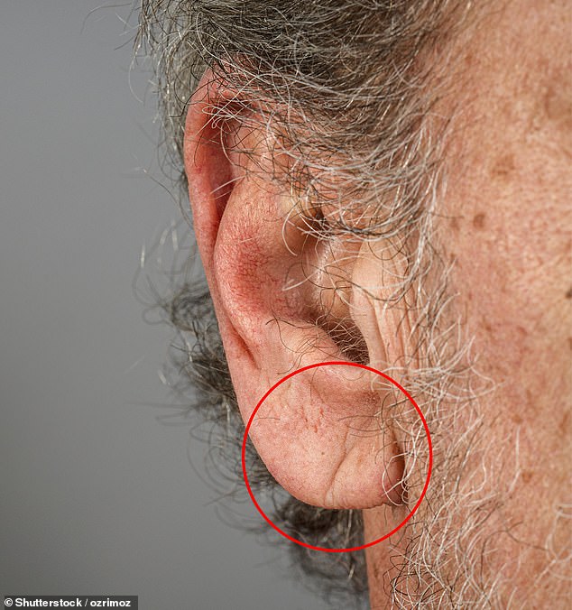 New Research Links Diagonal Earlobe Crease to Heart Disease Risk
